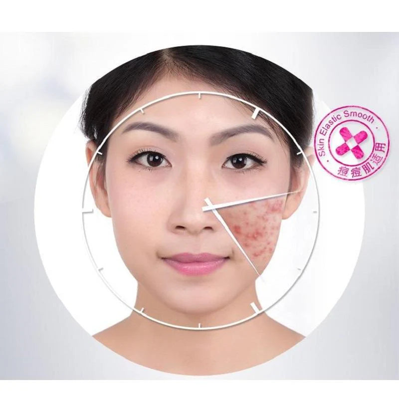 "BIOAQUA Anti Acne Cream Acne Scar Removal Cream BQY51278 "_0_image